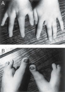 disease